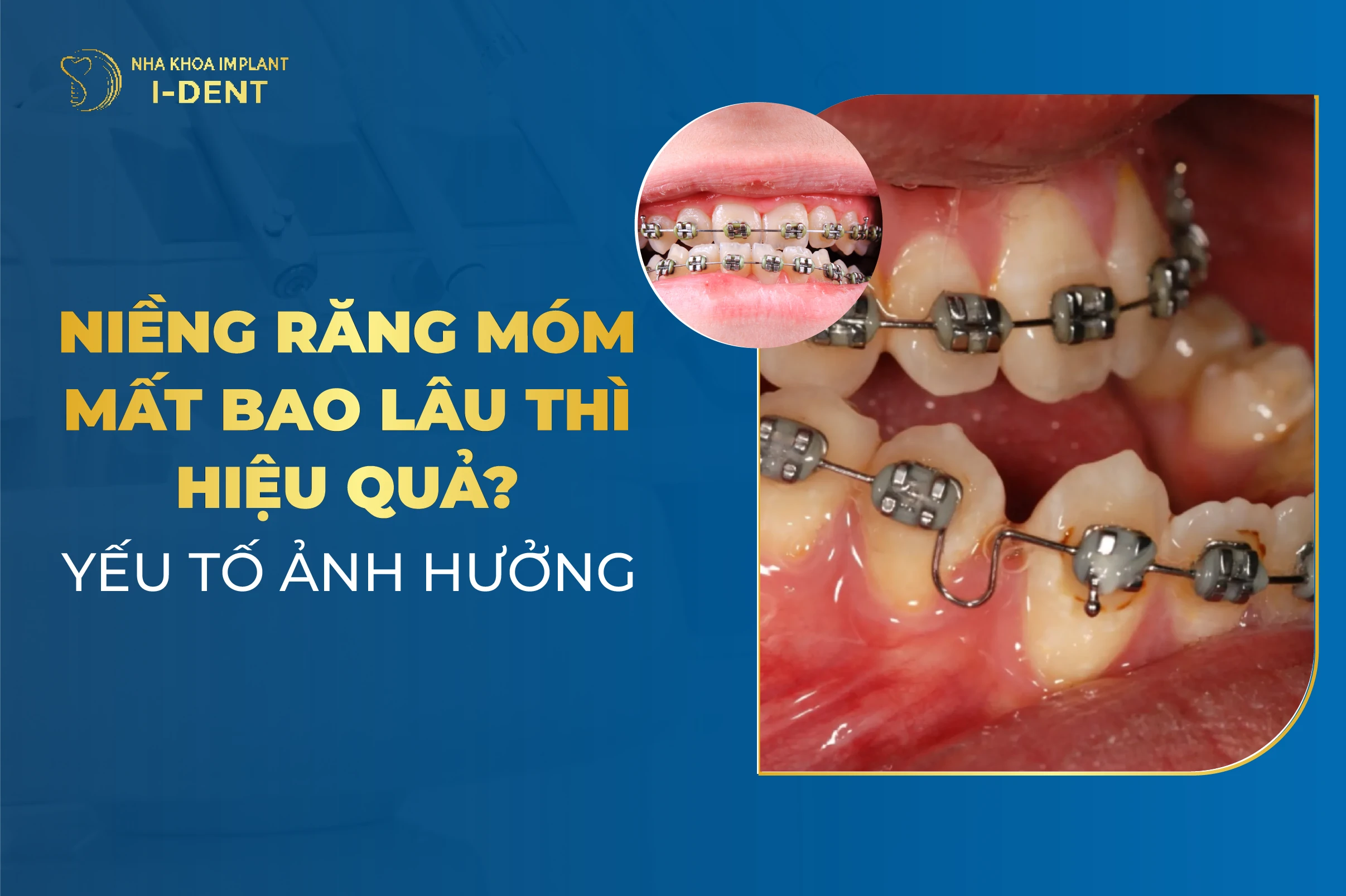 Niềng Răng Móm Trong Bao Lâu? Yếu Tố Ảnh Hưởng