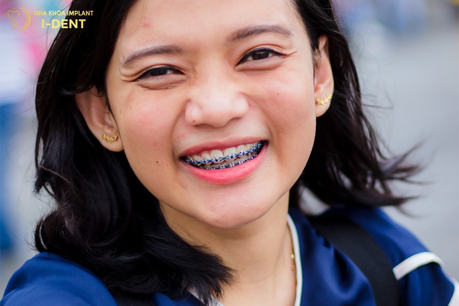 niềng răng người lớn