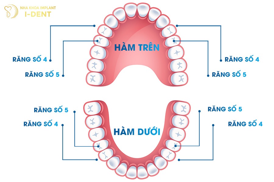 nhổ răng số 4 khi niềng răng