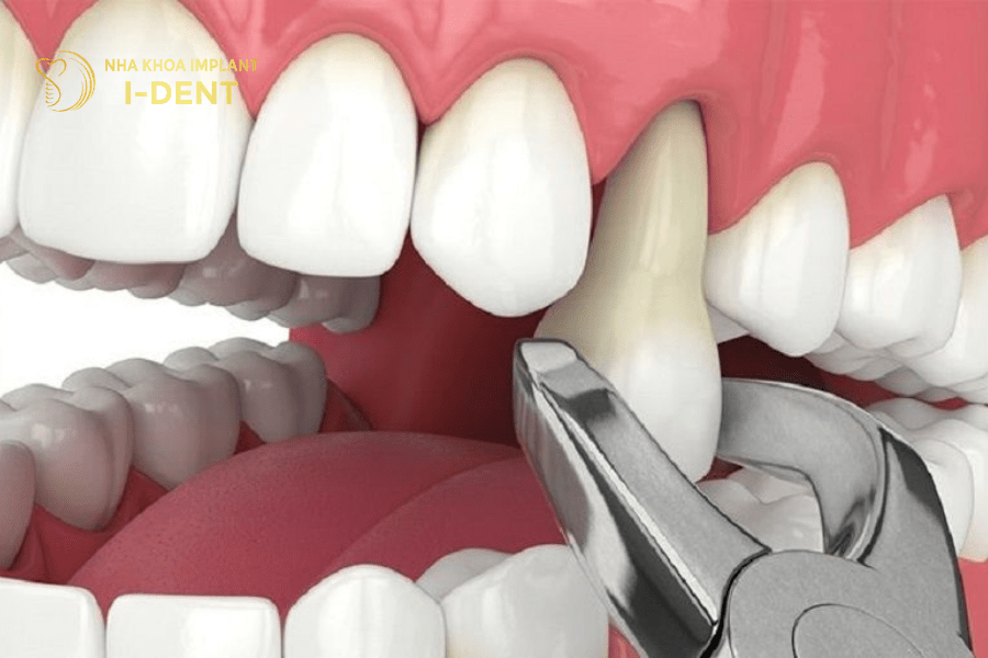 niềng răng phải nhổ răng số 4