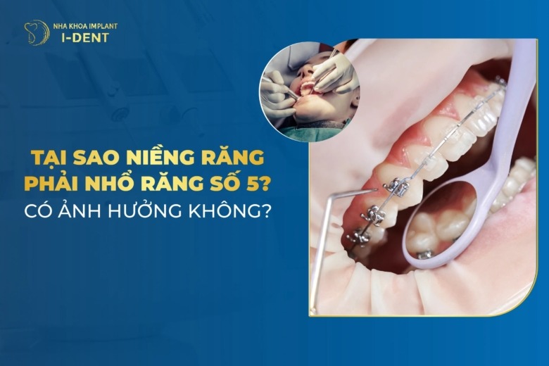 Niềng Răng Nhổ Răng Số 5 Có Ảnh Hưởng Gì Không?