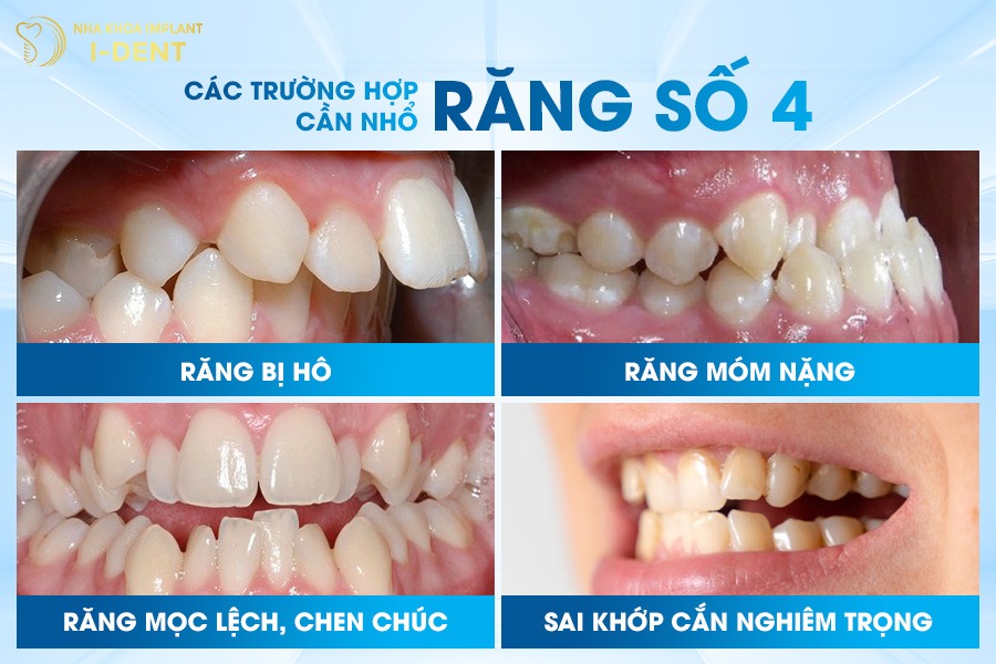 có nên nhổ răng số 4 để niềng không