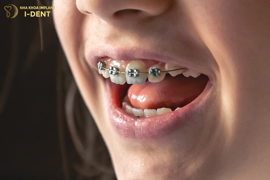 Thời gian niềng răng tốt nhất cho trẻ em là từ 10-14 tuổi