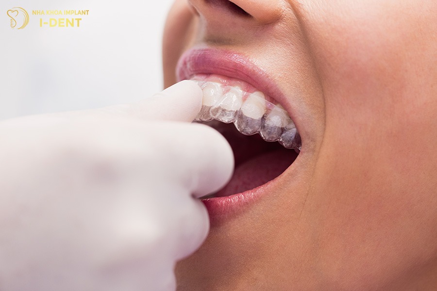 niềng răng trong suốt 1 hàm