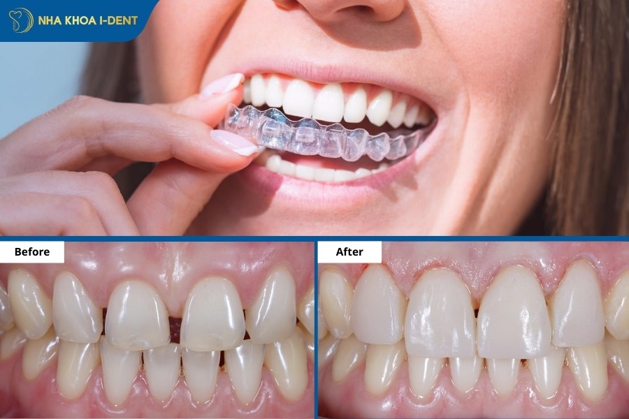 niềng răng trong suốt bao nhiêu tiền