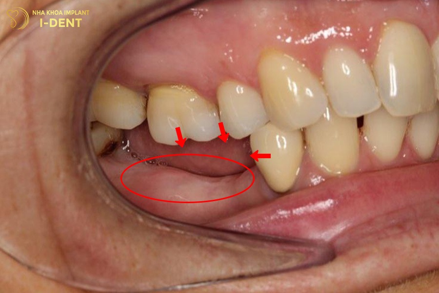 50 tuổi có niềng răng được không