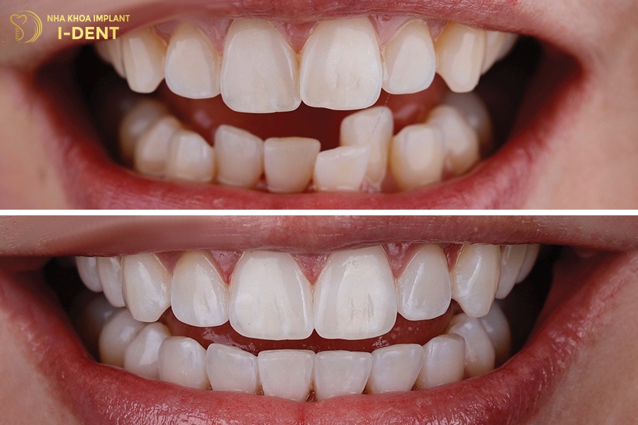 niềng răng vô hình giá bao nhiêu