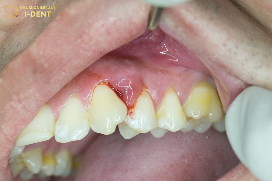 Nướu sưng đỏ và chảy máu khi chải răng.