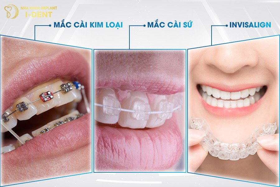 phương pháp khác nhau sẽ có mức giá niềng răng khác nhau