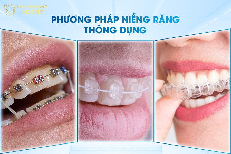 niềng răng cho trẻ 8 tuổi giá bao nhiêu