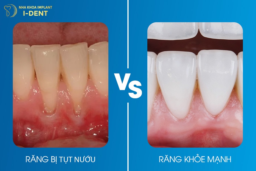 Nướu tụt khiến thân răng trông dài hơn.