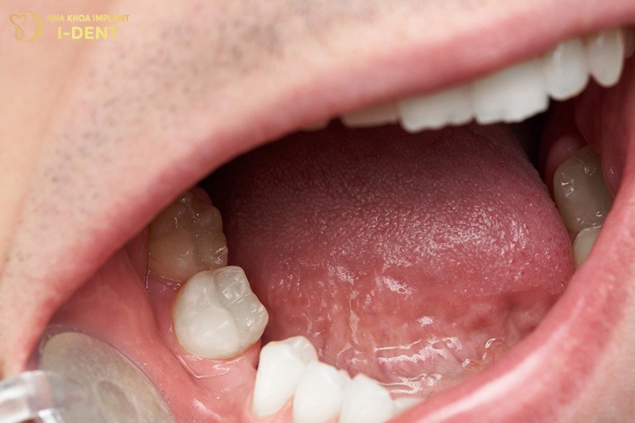 Khoảng trống mất răng làm các răng xung quanh di chuyển.