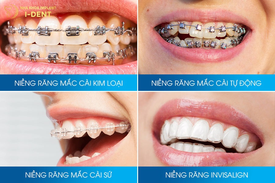 răng móm có niềng được không