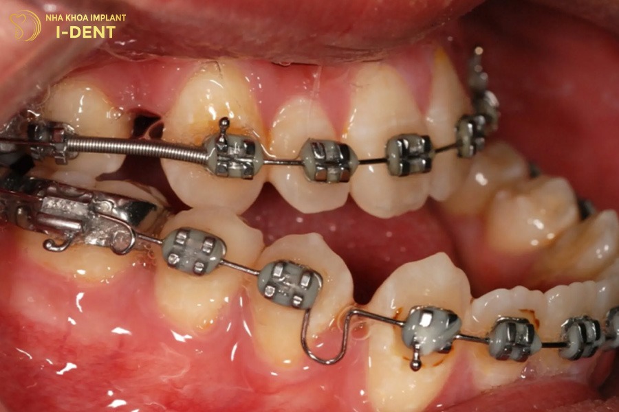 răng móm nặng sẽ có thời gian niềng dài hơn