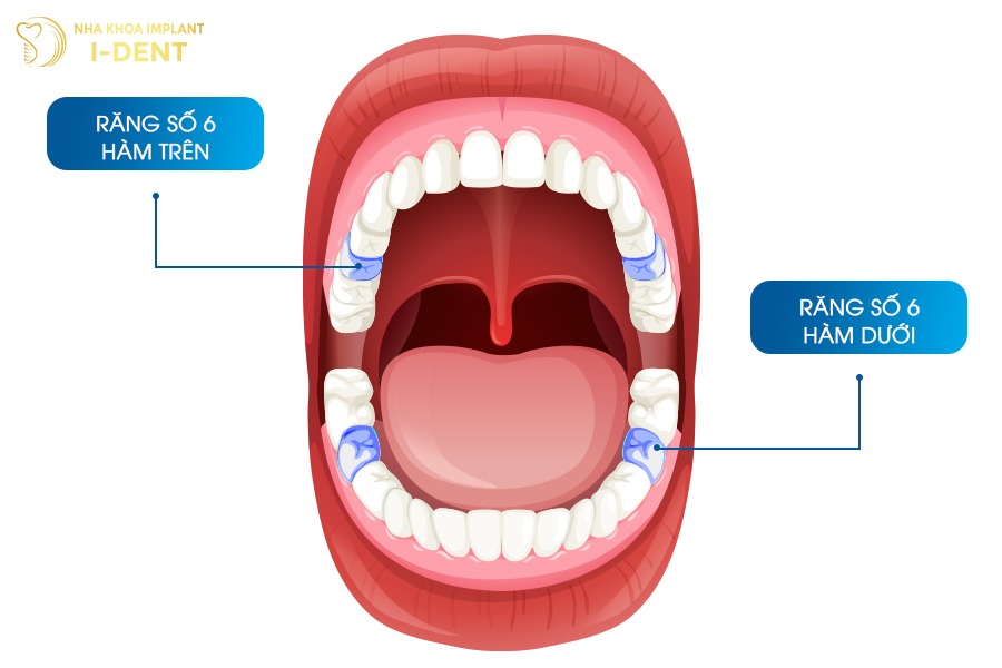 Răng số 6 là chiếc răng cối lớn đầu tiên trong hàm.