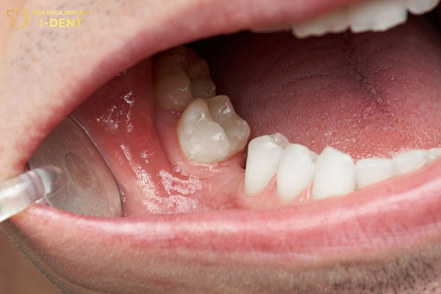 Khoảng trống mất răng khiến các răng kế cận nghiêng lệch, làm sai khớp cắn.