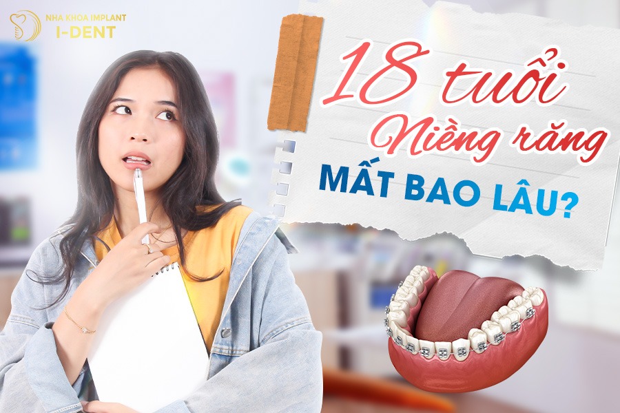 Thời gian niềng răng 18 tuổi từ 18 - 30 tháng