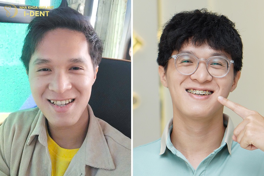 Thời gian niềng răng móm từ 1.5-3.5 năm