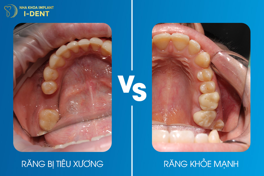 Tiêu xương răng ảnh hưởng đến thẩm mỹ và sức khỏe răng miệng.