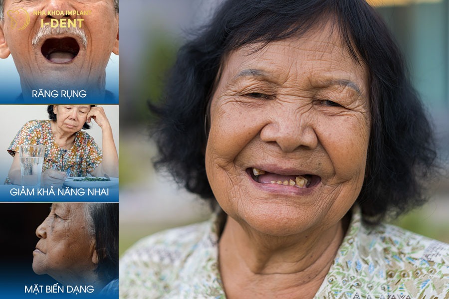 Tiêu xương răng suy giảm chức năng ăn nhai và thẩm mỹ nghiêm trọng.