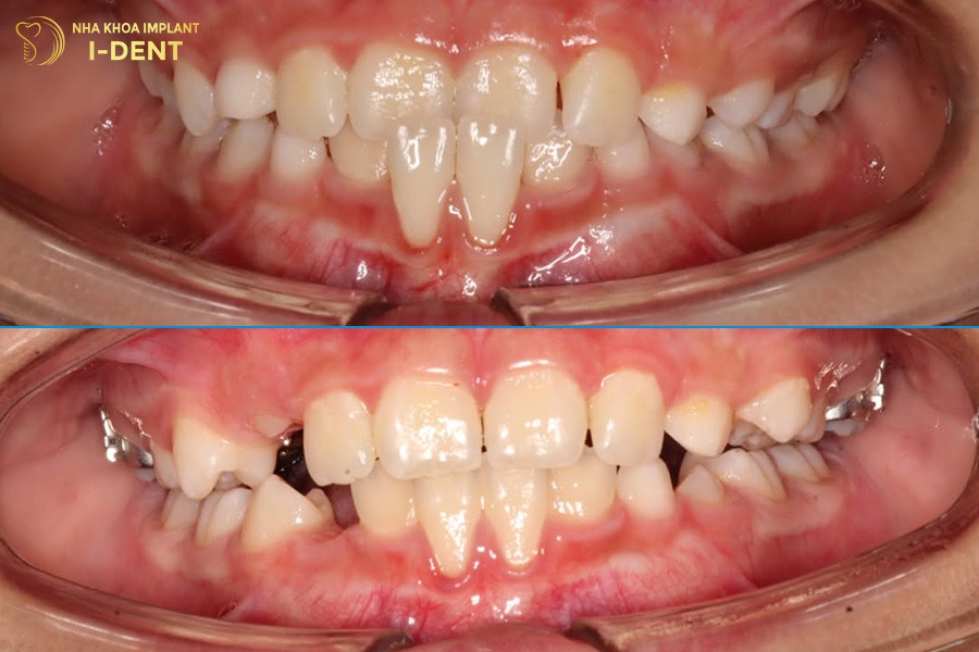 trẻ 13 tuổi niềng răng từ 16 - 36 tháng