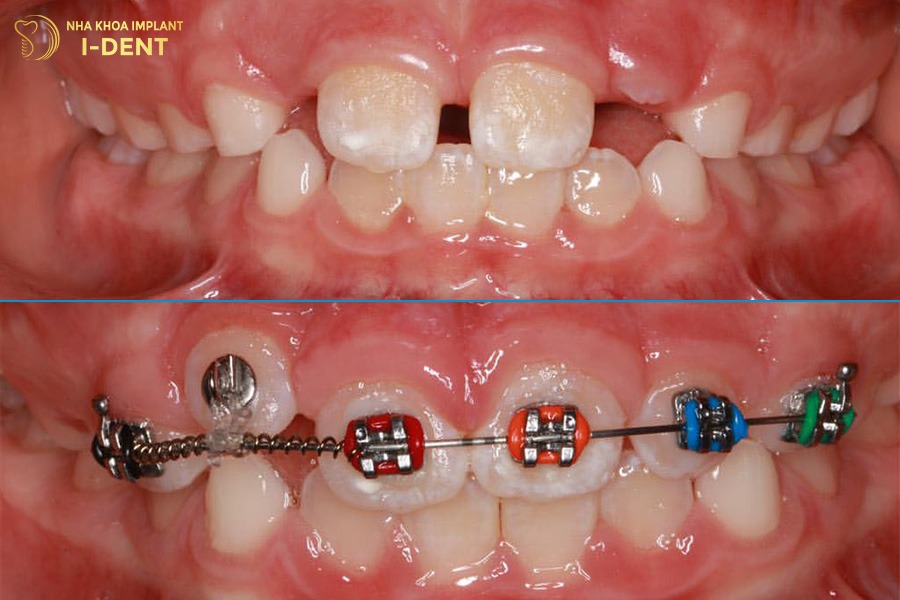 trẻ 13 tuổi trước và sau khi niềng