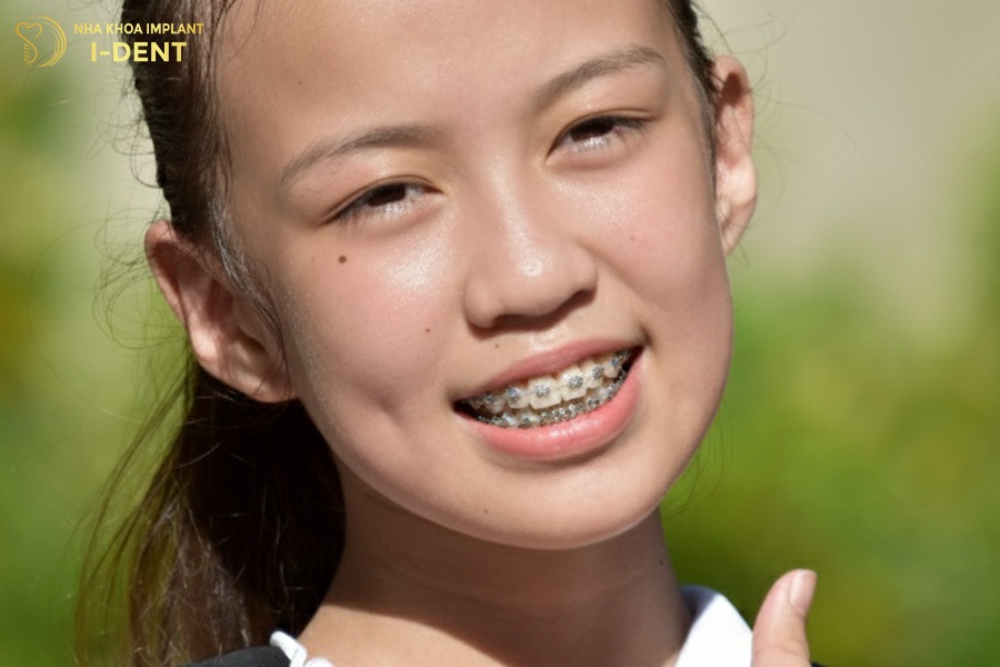 Trẻ 15 tuổi nên niềng răng sớm
