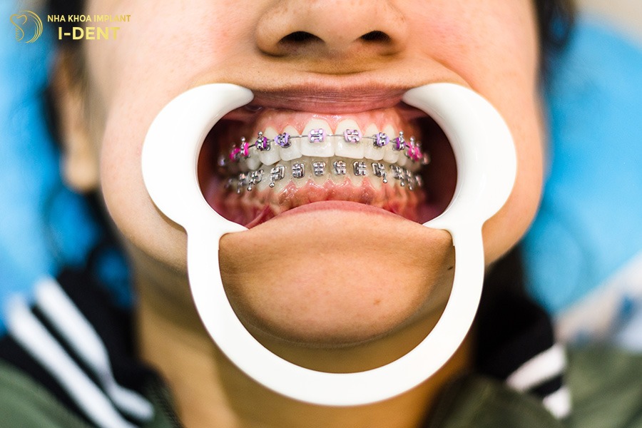 45 có nên niềng răng