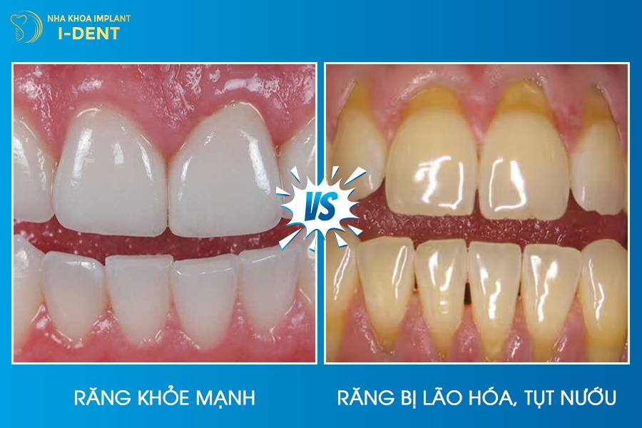 50 tuổi có niềng răng được không