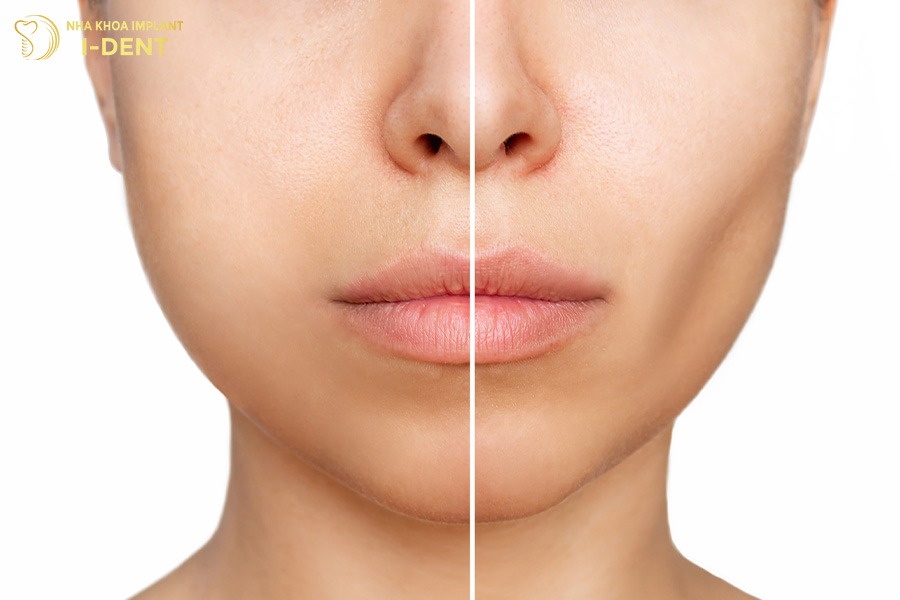 Trồng răng implant ngăn ngừa tiêu xương hàm.