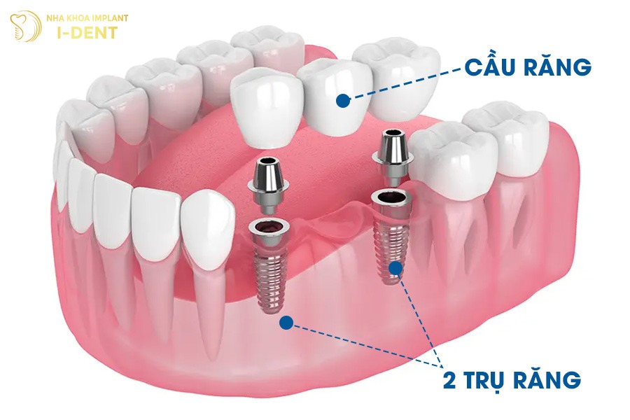 Trồng răng implant để phục hình răng số 6 đã mất lâu năm.