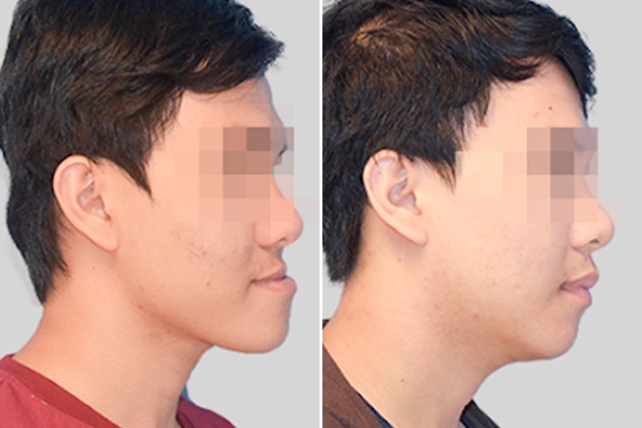 Vẩu xương hàm dưới/trên đã được cải thiện