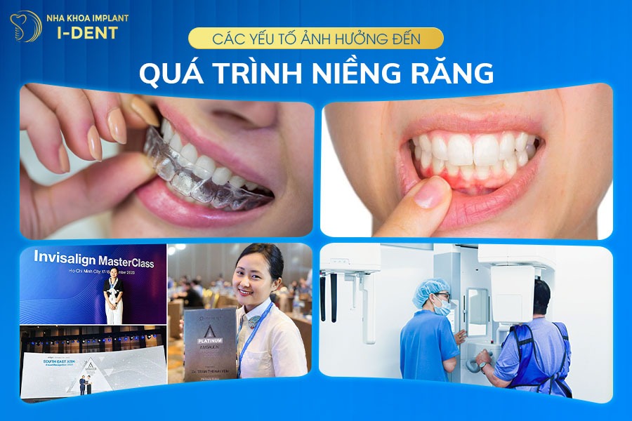 19 tuổi niềng răng bao lâu