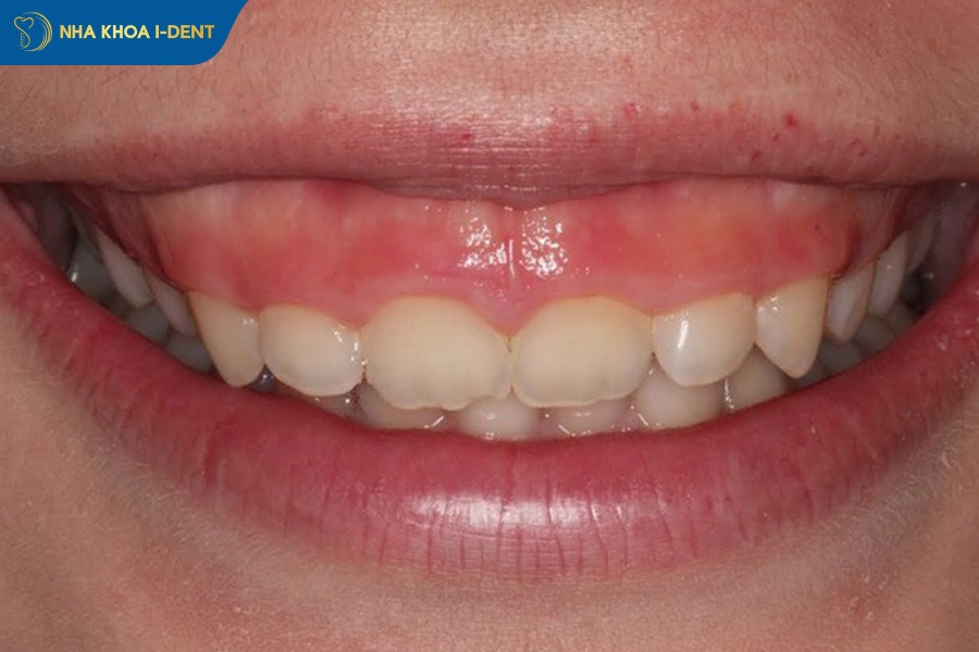 minivis niềng răng