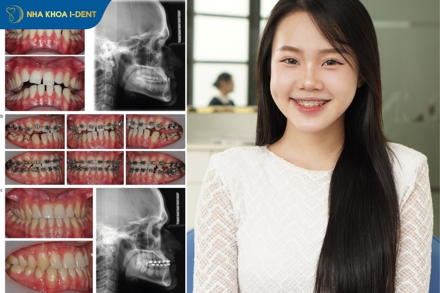 bị móm có nên niềng răng