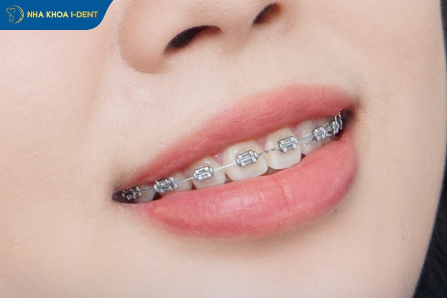 làm răng sứ có niềng răng được không