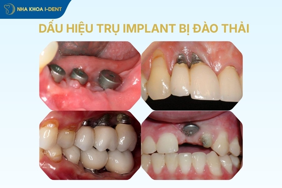 dau-hieu-tru-implant-bi-dao-thai