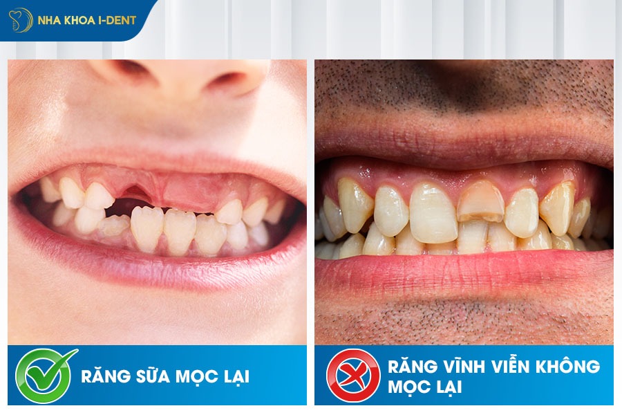 Trường hợp gãy răng cửa có mọc lại và không mọc lại