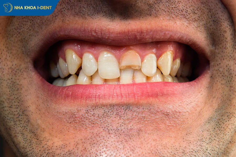 Gãy mất răng làm thiếu răng trên hàm mất tính thẩm mỹ