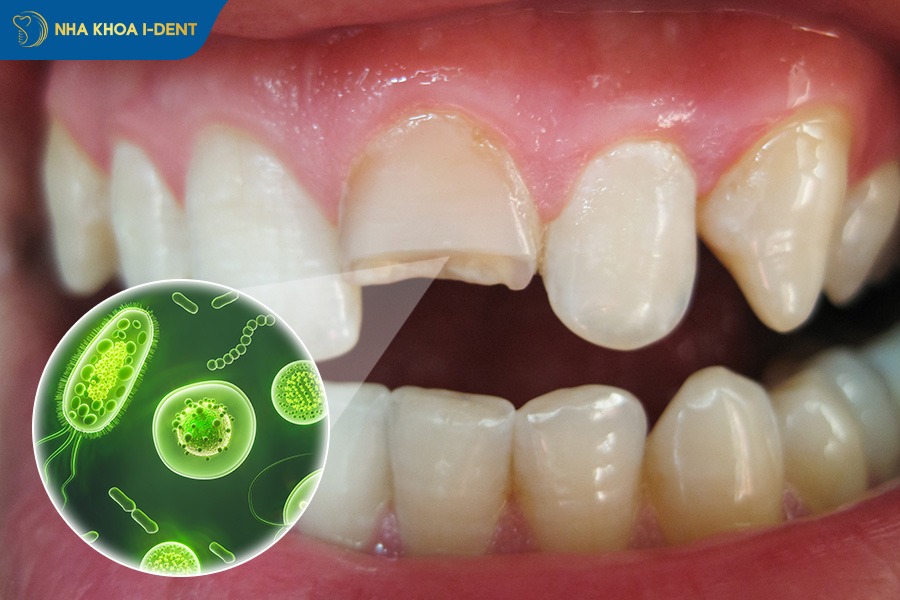 Gãy răng tăng nguy cơ mắc bệnh lý răng miệng