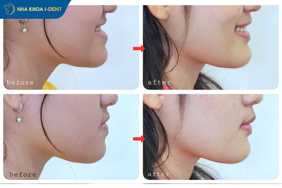 góc nghiêng trước và sau khi niềng răng