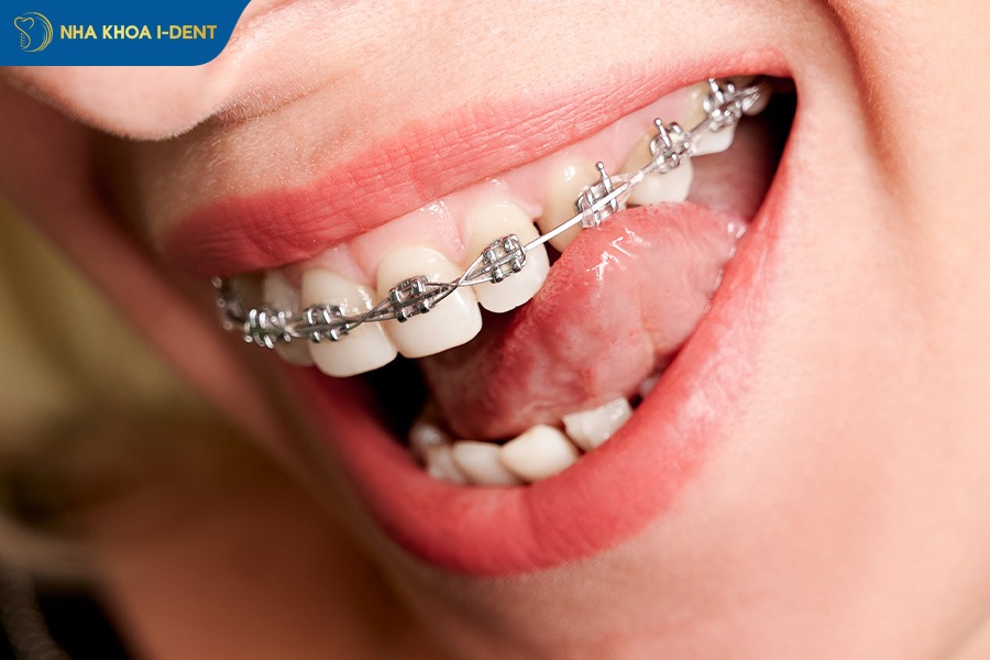 hở lợi khi niềng răng