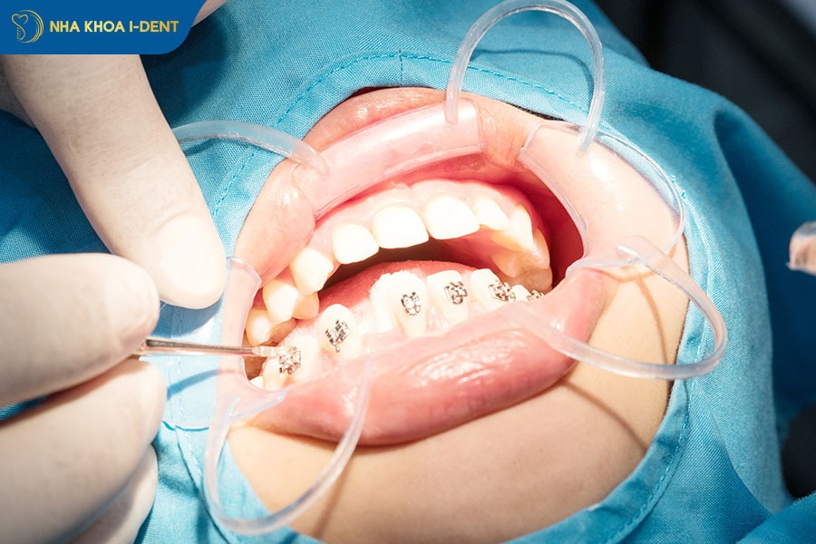 niềng răng khớp cắn hở mất bao lâu