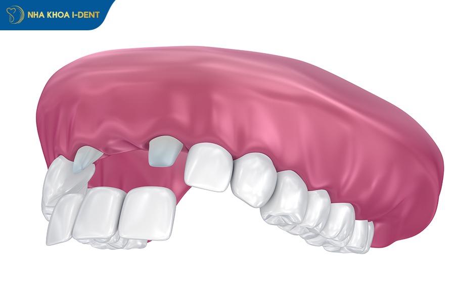 Phương pháp làm cầu răng sứ khi răng cửa bị gãy