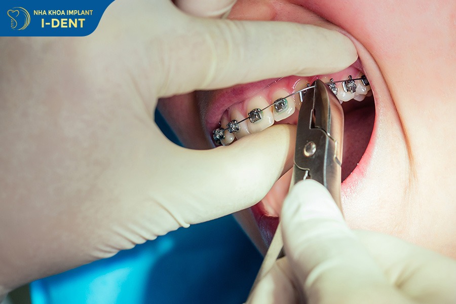 Dây cung được luồn vào rãnh mắc cài