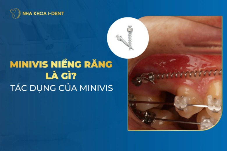 Minivis niềng răng là gì? Có tác dụng thế nào? Những trường hợp chỉ định