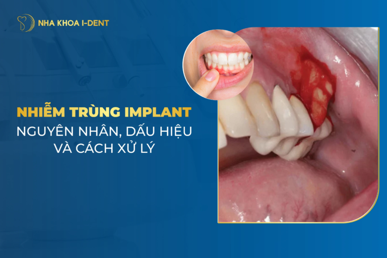 Nhiễm trùng implant sau khi cấy do đâu? Dấu hiệu và Cách khắc phục