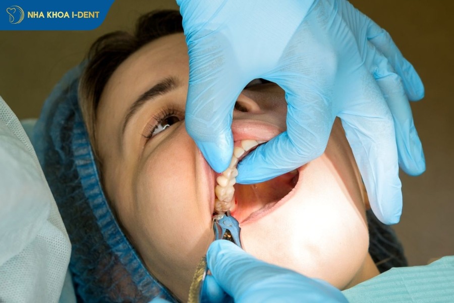 nhổ răng khôn để tạo khoảng trống