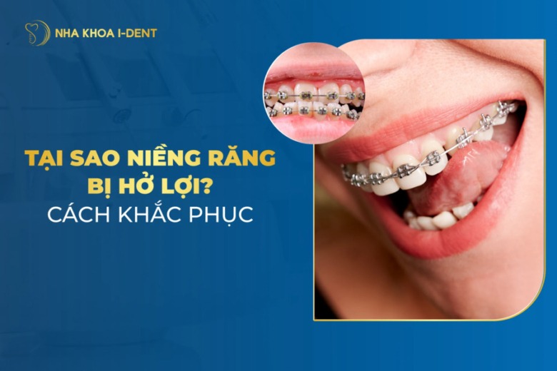 Tại Sao Niềng Răng Bị Hở Lợi? Cách Khắc Phục