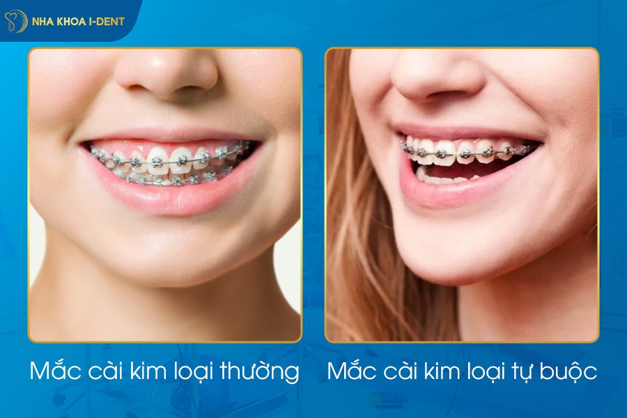 niềng răng bị lệch khớp cắn